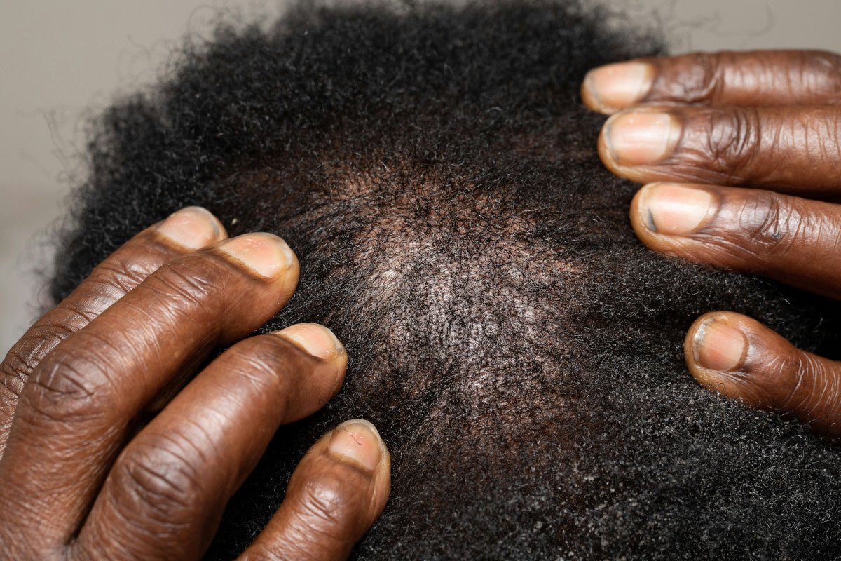 Copper Peptides For Scalp: