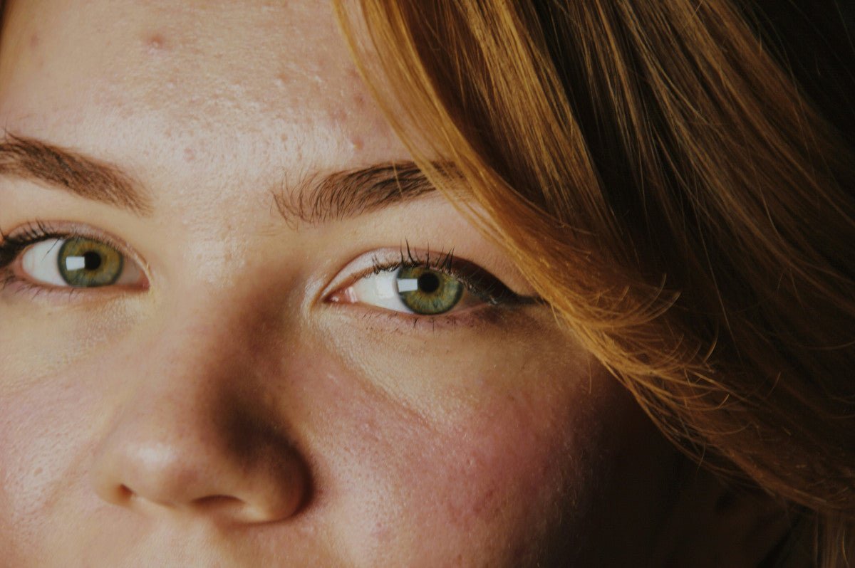 topical peptides for acne